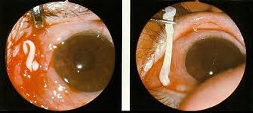 giun-san-trong-co-the