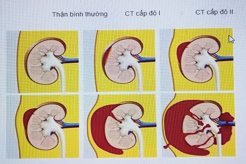 Triệu chứng chấn thương thận kín là gì? Cách điều trị bệnh ra sao?